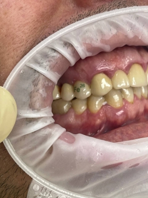 Ставропольчанин после визита к стоматологу показал «железную» улыбку